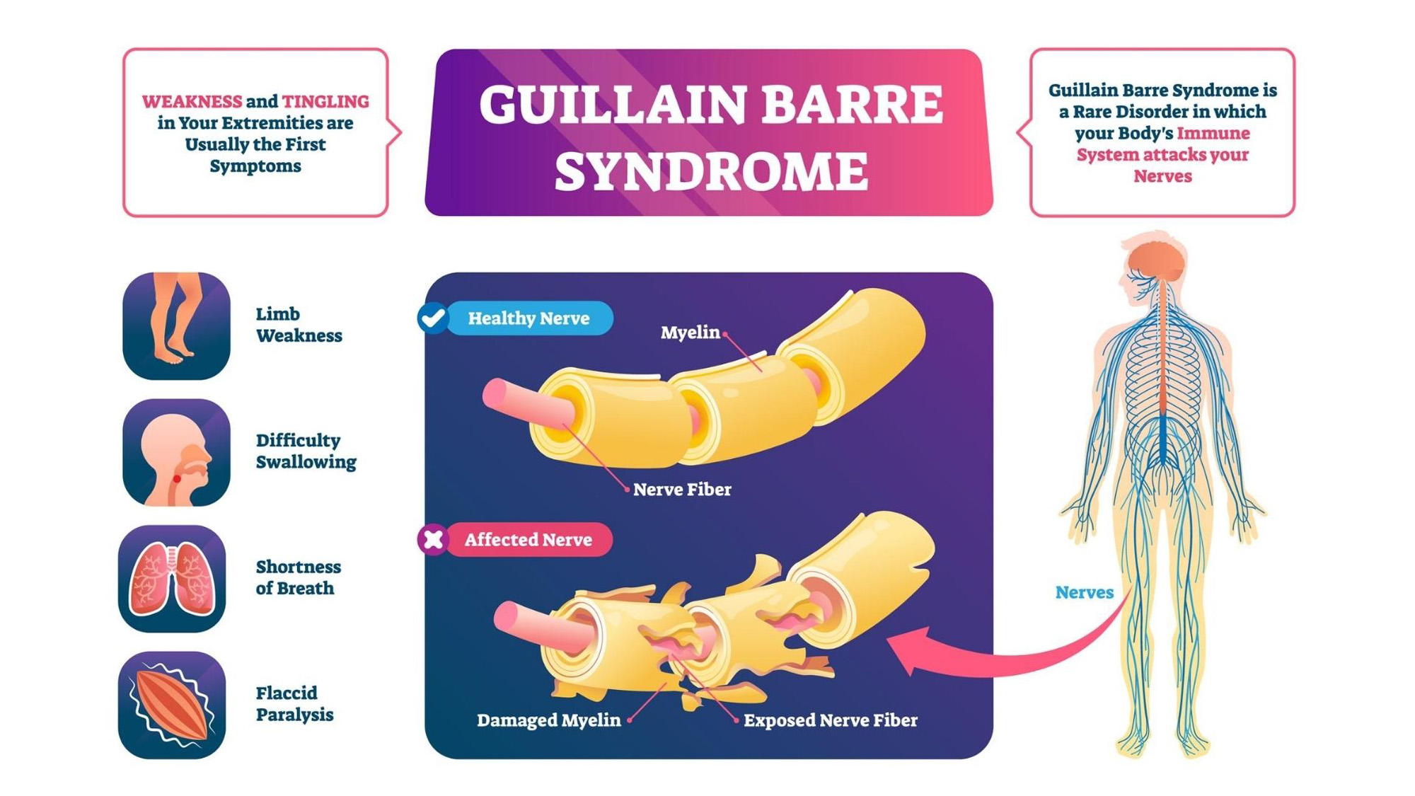 Guillain-Barré syndrome | Causes | Symptoms | Types | Treatment, and care | Treatment at home | When to seek a neurologist?