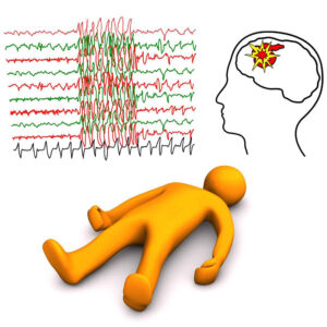Symptoms of Epilepsy and Seizure triggers
