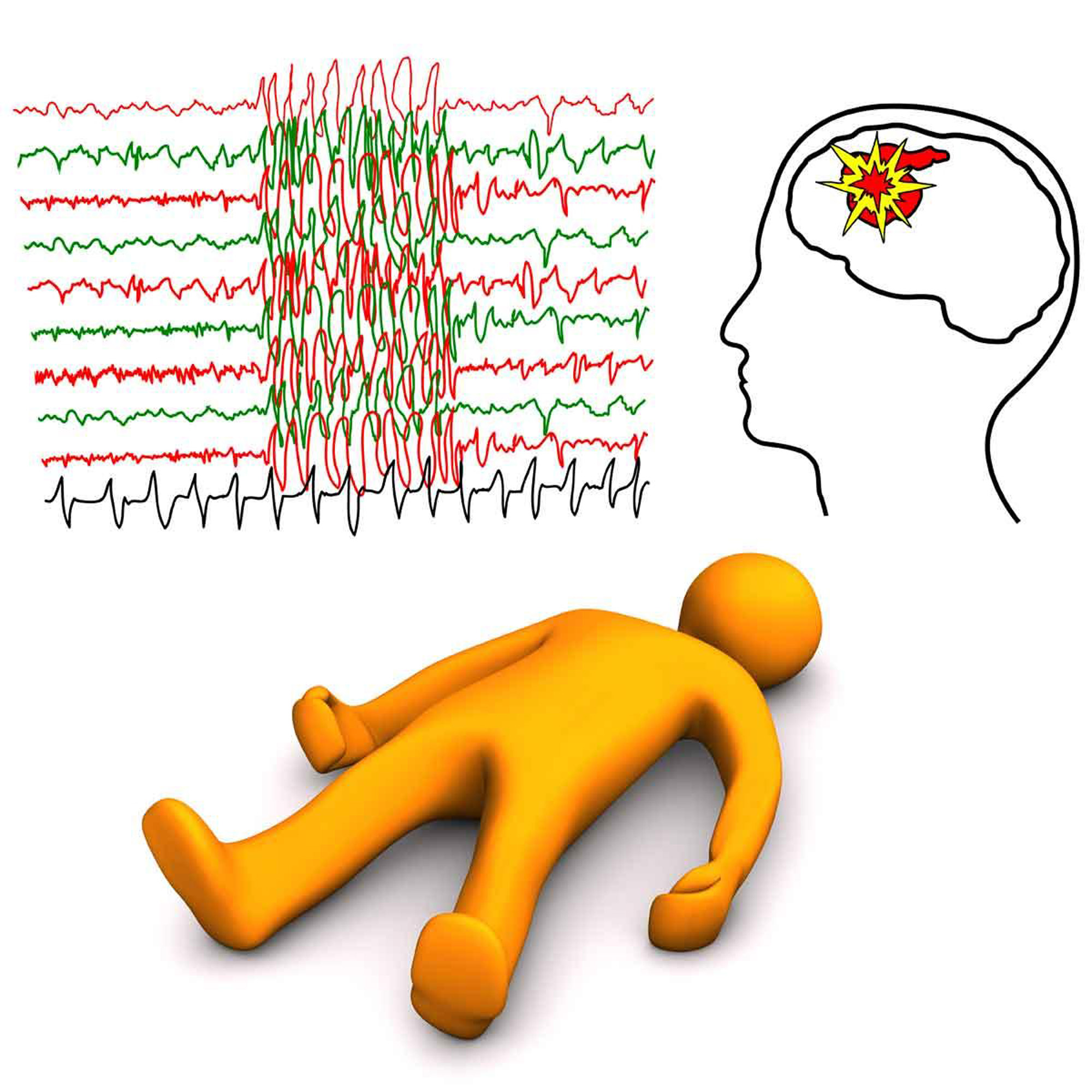 Symptoms of Epilepsy and Seizure triggers | Dr. Pankaj Singh